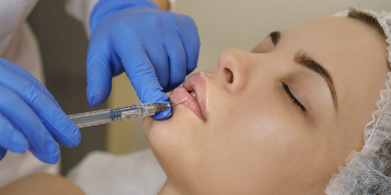 Hyaluron_Lippenvolumen_Mainz